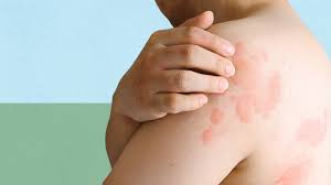 Hives