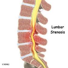 Spinal stenosis